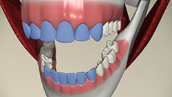 Teeth Whitening video