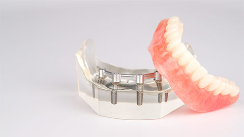 supported dental implant