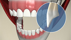 Veneer (Cracked Tooth)