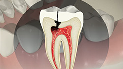 Root Canal (Direct Post and Core)