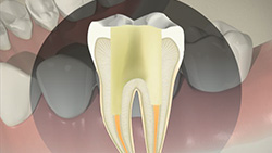 Root Canal (Indirect Post and Core)