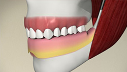 Implant (Bar-Supported Denture)