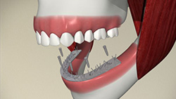 Implant (Supported Denture)