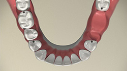 Partial Denture