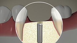 Implant (Cemented Crown)