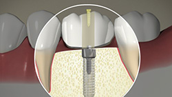 Implant (Screw-Fixed Crown)