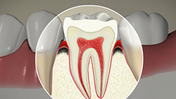 About Periodontal Disease