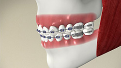 Getting to Know Your Braces